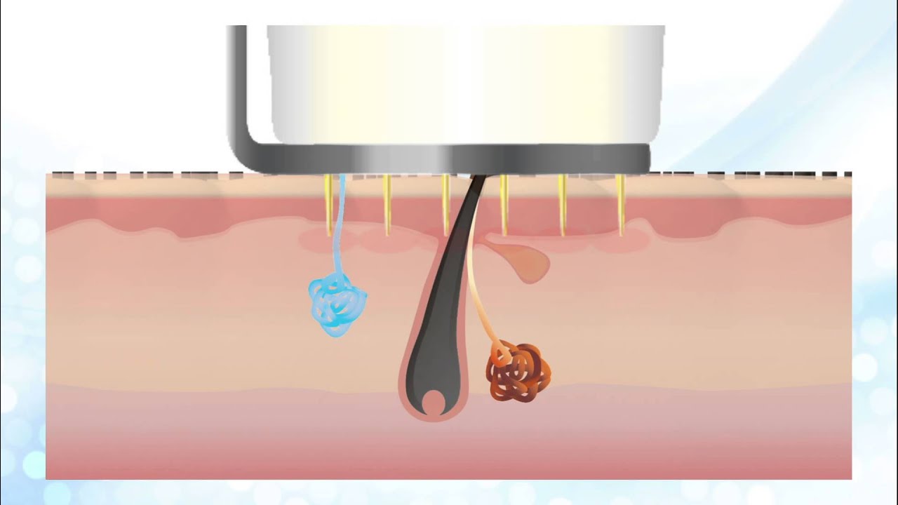 ViewHOT（ ビューホット） ～フラクショナルRF（高周波）を用いた新しいわきが・多汗症治療～