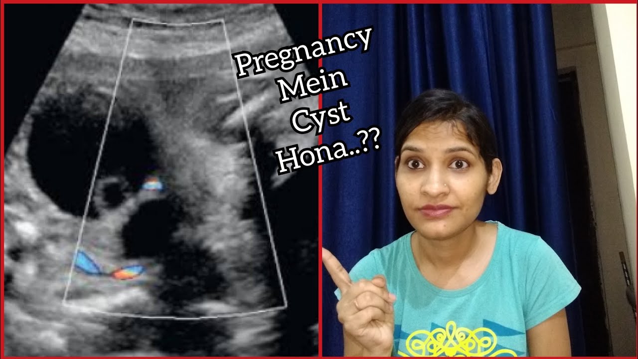 Ovarian Cyst In Hindi... YouTube