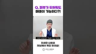 두꺼운 피부, 매몰법 안된다는 건 오해?!