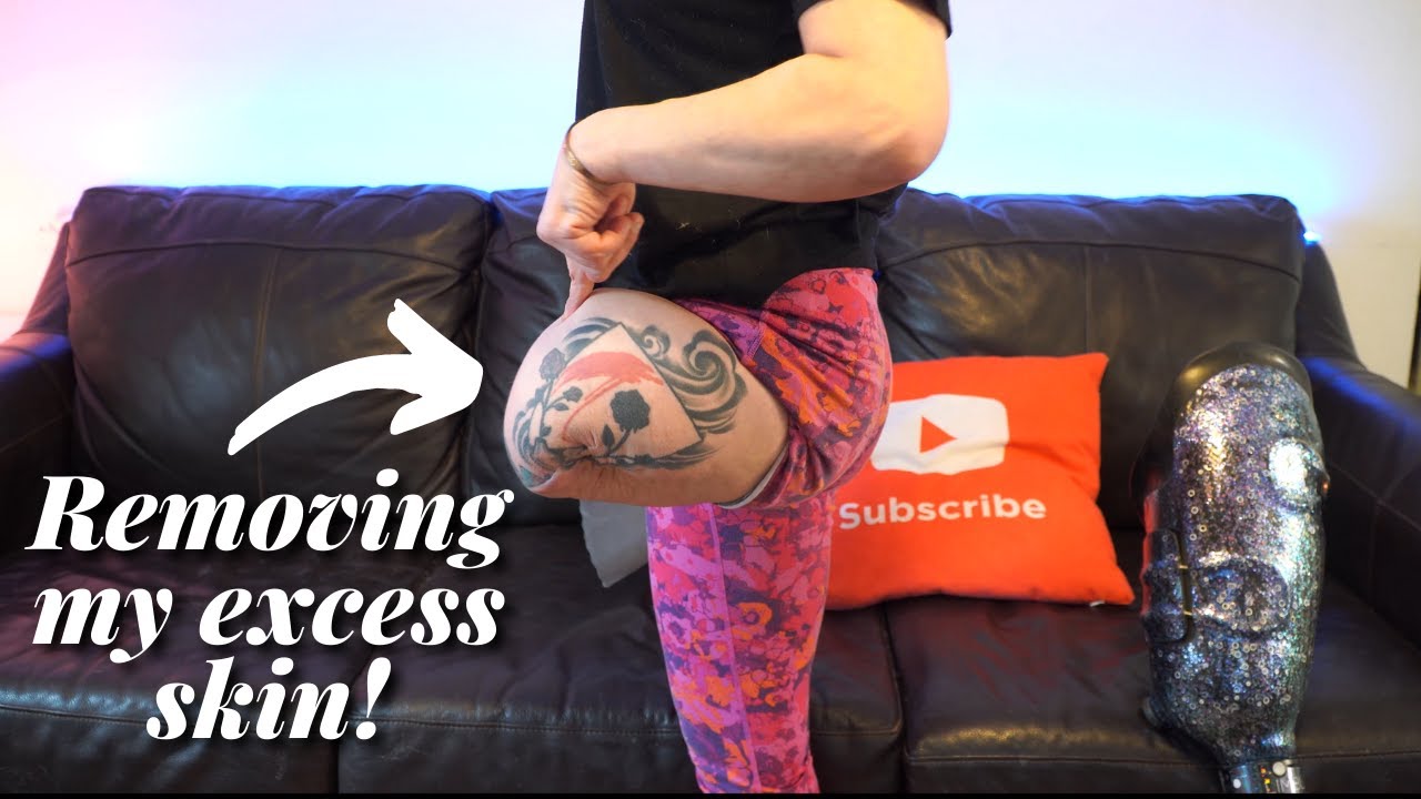 Почему мне предстоит ТРЕТЬЯ операция на культе выше колена