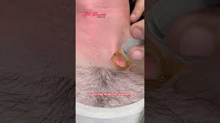 Laser Hair Removal Treatment #getsmarthairclub #hairmaster #viralvideo #hair #hairlosstreatment