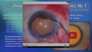 Доклад на тему: Сложные случаи хирургии катаракты