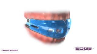 Edge Animations Sports Mouthguard (Audio) Edge Animations Normal Occlusion Audio