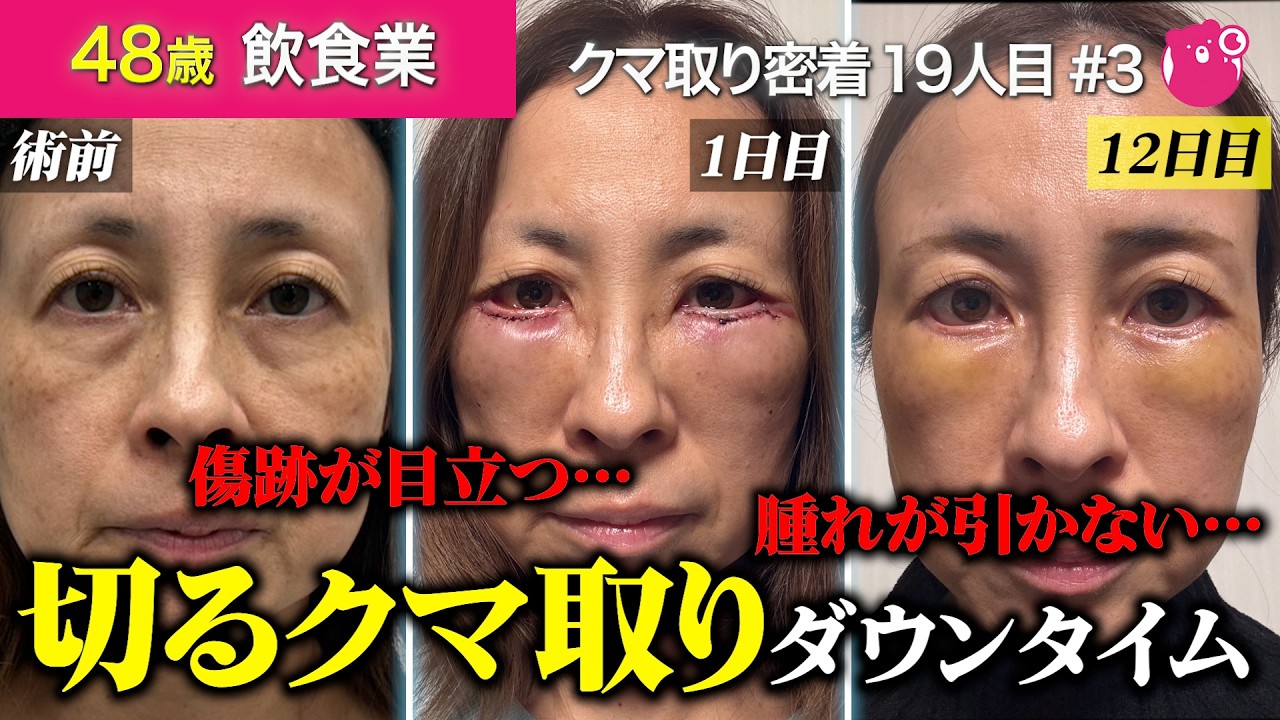【目の下のクマ取りダウンタイム】表ハムラを受けた48歳女性の目元の傷跡・腫れはどうなる？1ヶ月に完全密着！#ダウンタイム #目の下のたるみ取り #表ハムラ #美容整形 #湘南美容クリニック