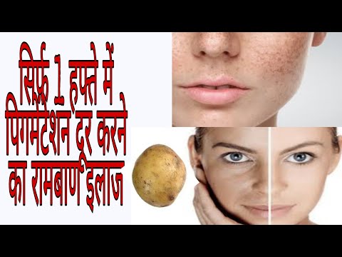 Pigmentation दूर करने के घरेलू नुस्खे || How To Remove Pigmentation ||classy style tips with shikha