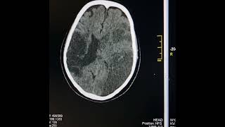 Differences between acute and chronic cerebral infarcts. An undergraduate assistance.
