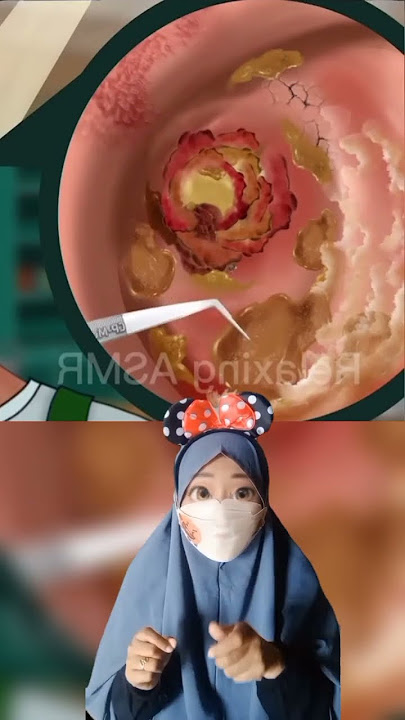 ASMR part 62 Keluar cairan dari Telinga 😱 |Mv #shorts