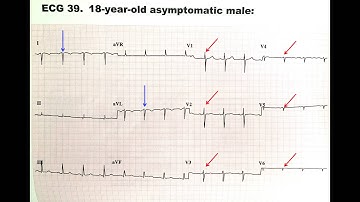 Dextrocardia Dr. Uri Ben-Zur asymptomatic male ekg ecg electrocardiogram