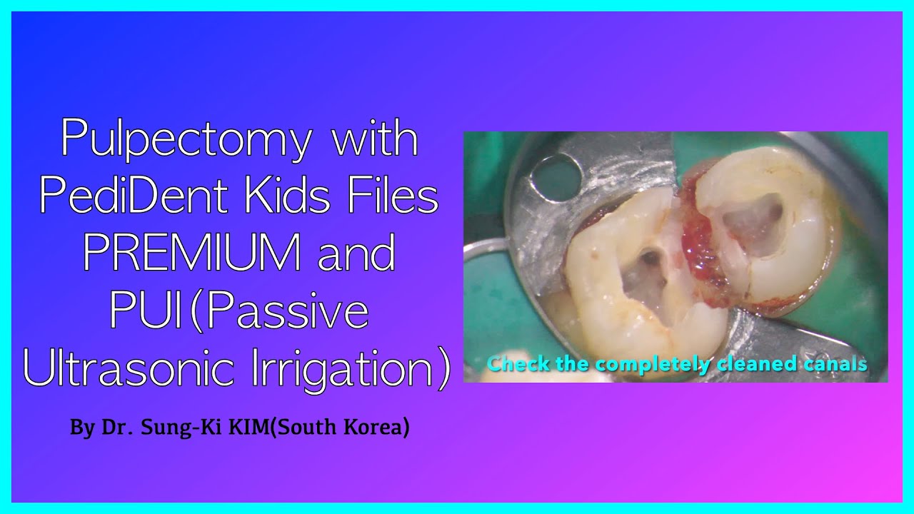 Pulpectomy with PediDent Kids Files PREMIUM and PUI(Passive Ultrasonic Irrigation) YouTube
