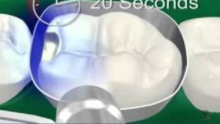 Class II Composite.FLV
