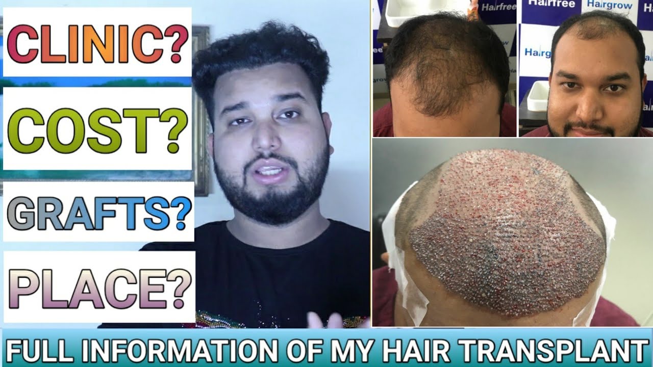 My 9 months best hair transplant result best hair transplant in