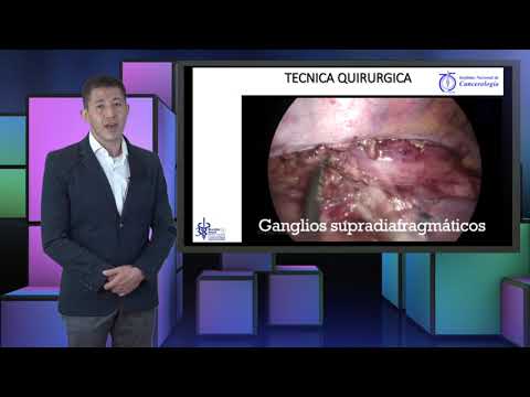 Esofagectomía Radical Toracoscópica en posición prono para tratar el Cáncer de Esófago