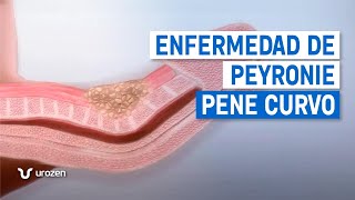 ¿Tienes Una Curvatura En El Pene? Descarta La Enfermedad De Peryonie