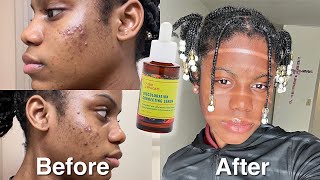 I Tried Good Molecules Discoloration Correcting Serum For 2 Weeks | Before & after Review + Results