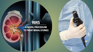 RIRS - Retrograde Intrarenal Surgery | Laser for Kidney Stone