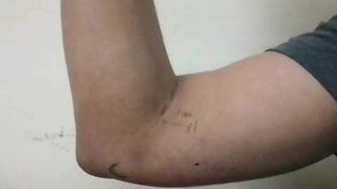 How to palpate epitrochlear lymph nodes. Clinical examination video by SIMPLE Orthopaedics