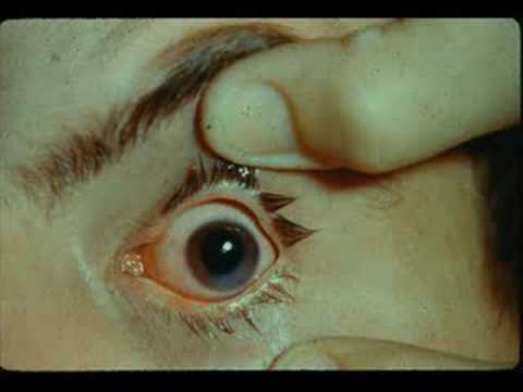 Injuries and Chemical Burns to the Eye - YouTube