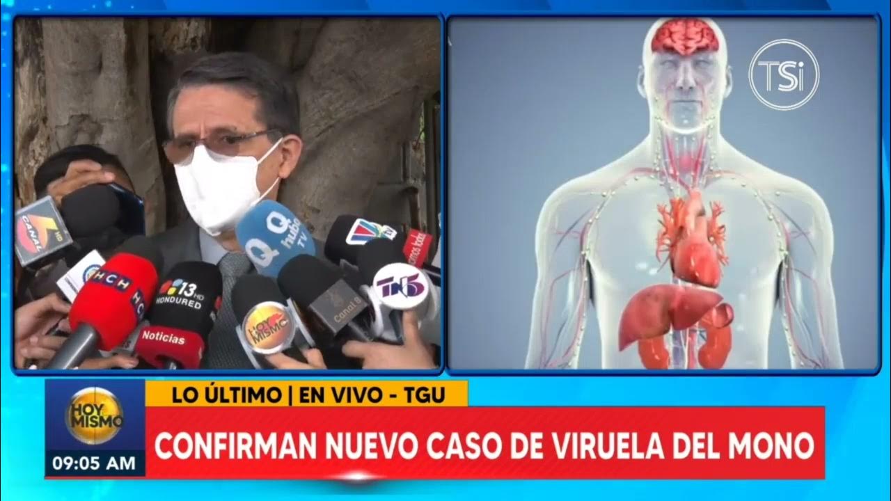 Cuanto tiempo dura la viruela del mono