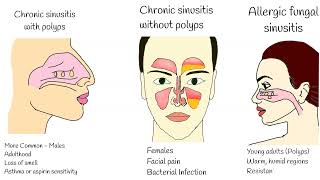 Chronic Sinusitis - Symptoms, causes and treatment.  Sinusitis with polyps, Fungal sinusitis