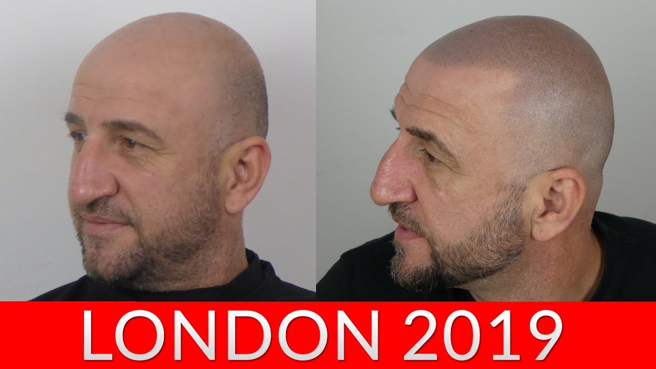 Scalp Micropigmentation Specialists London  HAIR ink Clinic