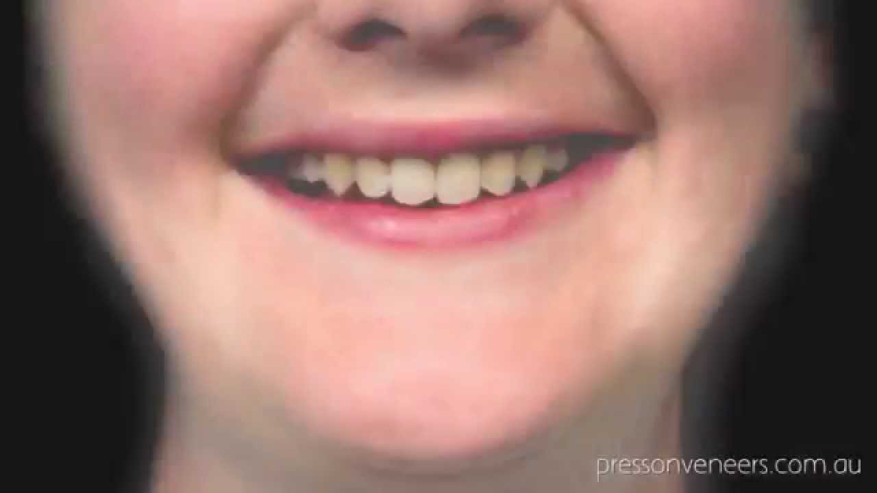 Press On Veneers vs Snap On Smile Dentist in Sydney Australia YouTube