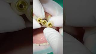 🦷위어금니임플란트🇰🇷🏥😍 #dentist #dental