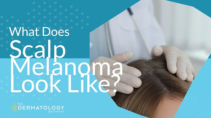What Does Scalp Melanoma Look Like?
