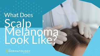 What Does Scalp Melanoma Look Like?