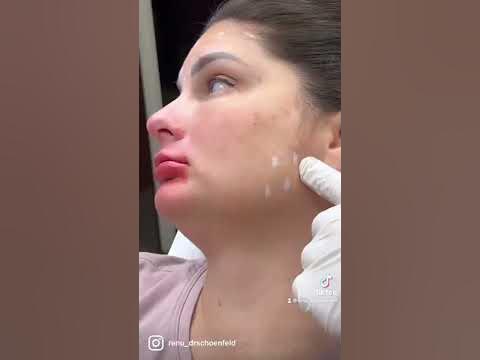 Botox to treat TMJ 