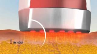 Silk׳n Reju Skin Rejuvenation and Anti Aging Device by CurrentBody.com
