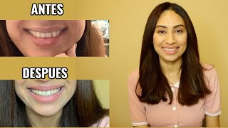 INVISALIGN mi EXPERIENCIA