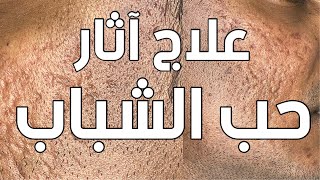 جلسة علاج آثار حب الشباب مع الدكتور وليد زاده