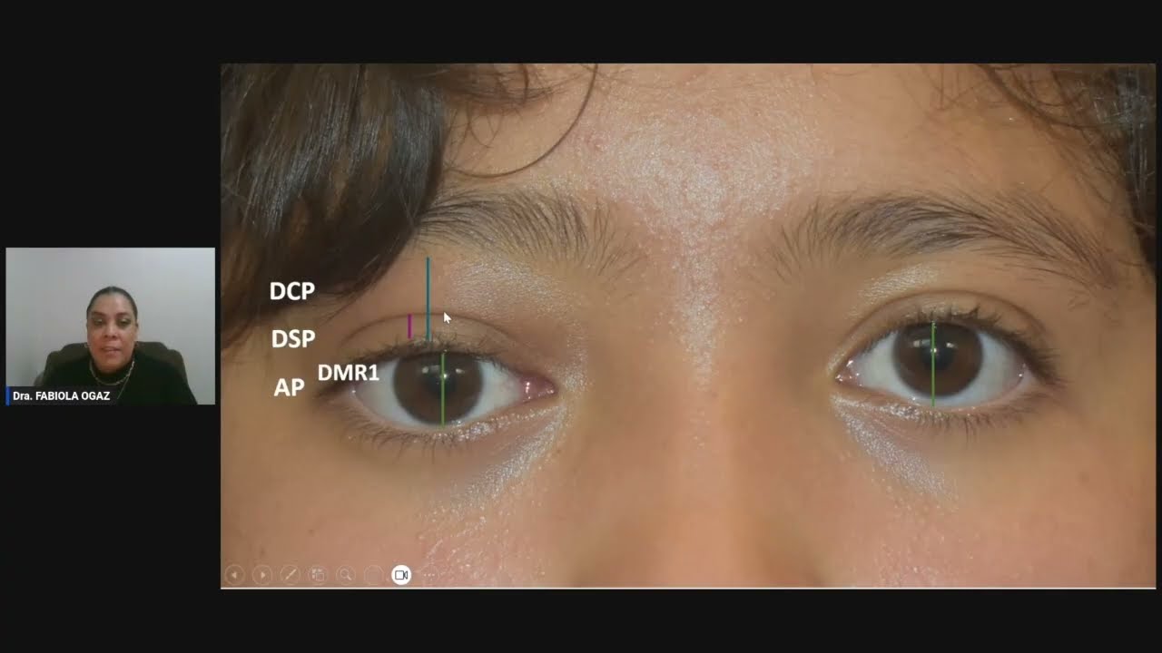 Cuando la inflamación ocular compromete los anexos