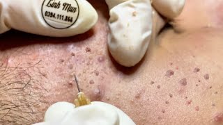 Massive Forehead Congestion Removal – Dense Comedone Extraction | Spa Linh Mun #41