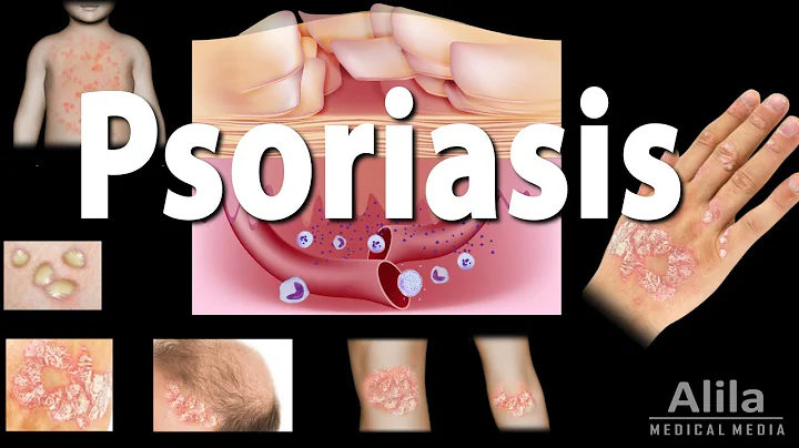 Psoriasis: Types, Symptoms, Causes, Pathology, and Treatment, Animation - DayDayNews