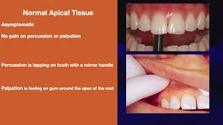 Download Lagu Endodontics  Diagnosis/Pulpal pain and periodontal pain MP3