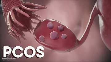 menstruation and  Polycystic Ovary Syndrome or PCOS | Causes |Treatments|Dandelion Medical Animation