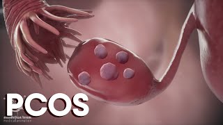 menstruation and  Polycystic Ovary Syndrome or PCOS | Causes |Treatments|Dandelion Medical Animation screenshot 4