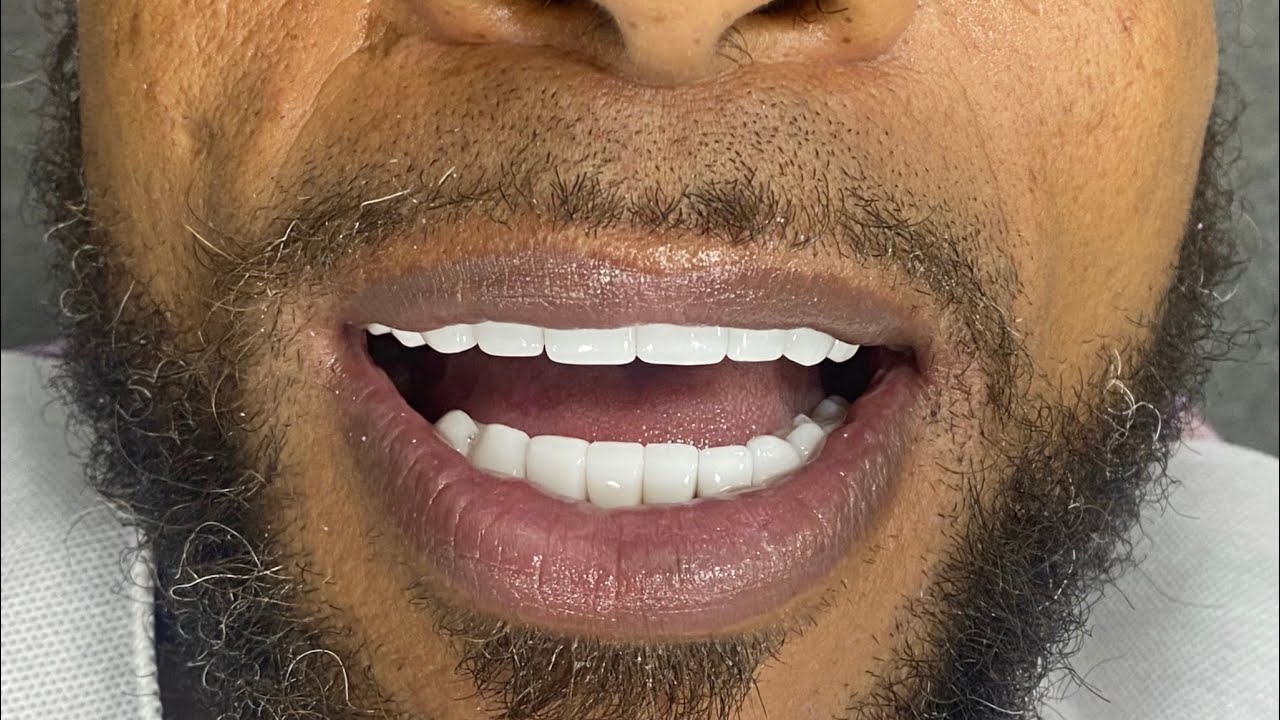 PORCELAIN VENEERS VLOG BILLION DOLLAR SMILE DR. MARIO MONTOYA YouTube