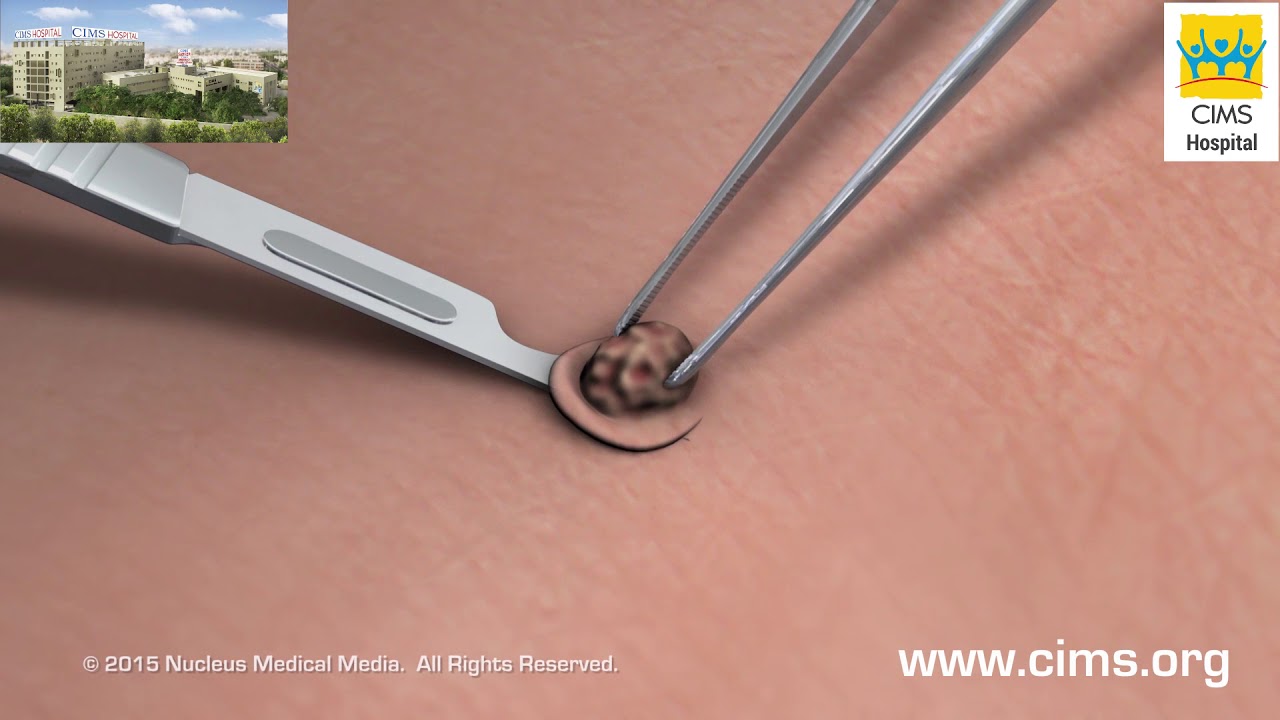 Skin Biopsy - CIMS Hospital - YouTube