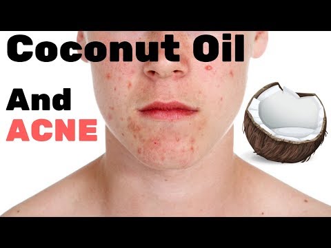 Coconut Oil and Acne: Does it Cause Acne or Cure It?