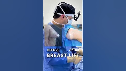 Dr.Enrique 👨‍⚕️#beforeandafter of #breastlift 🍒 #certified #beauty #bodycontouring #surgeryday