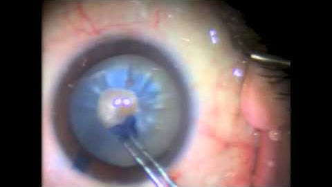 "Little" Capsulorhexis Rescue Technique