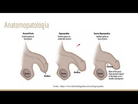 Vídeo: Hipospádia - Cirurgia, Capitato E Hipospádia De Tronco Em Meninos
