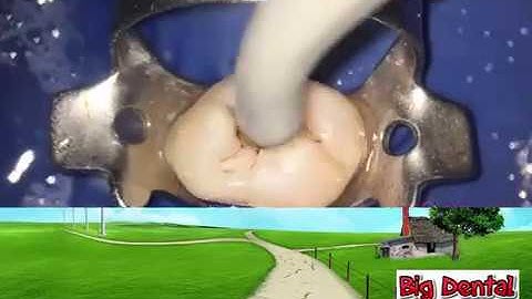 B.D: Mở tủy răng cối lớn hàm trên