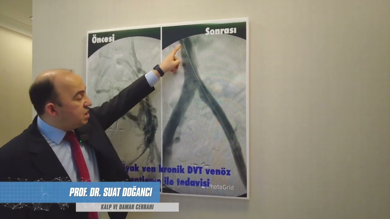 Kronik derin ven trombozunda venöz stentleme nasıl yapılır? | Prof. Dr. Suat DOĞANCI