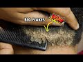 Big Flakes Return Back? Scratching Dandruff Flakes On Back View #441