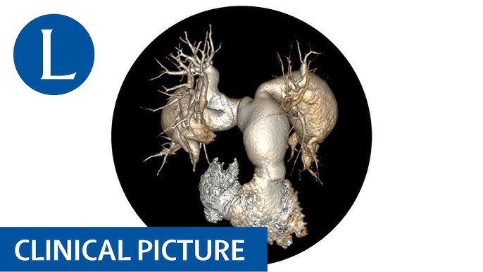 Streptococcal toxic shock syndrome revealed phlegmasia cerulea dolens of  the arm - The Lancet Infectious Diseases