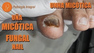 Uña micótica  Fungal nail  Unha micótica [Podología Integral]