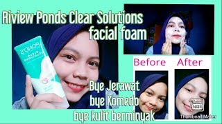 HILANGKAN JERAWAT DALAM 3 HARI | REVIEW PONDS ACNE SOLUTION | Tips Mengatasi jerawat | ine wiana